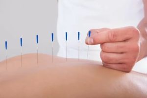 Можно ли делать иглоукалывание при эндометриозе