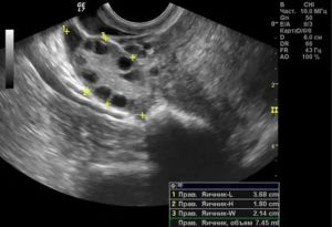 Чтобы пройти узи яичников что для этого нужно