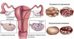 Можно ли делать эко при эндометриозе яичников