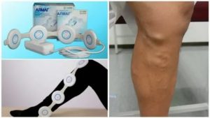 Можно ли пользоваться алмагом при эндометриозе