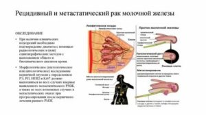 Потеря аппетита при раке молочной железы