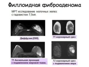 Мрт диагностика фиброаденомы молочной железы