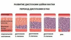 Какими препаратами лечить дисплазию шейки матки 1 степени
