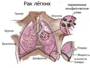 Жидкость в легких причины и лечение при онкологии молочной железы