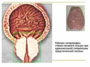 Гипертрофия предстательной железы и стенки мочевого пузыря
