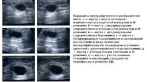 Что такое киста молочной железы с пристеночным компонентом