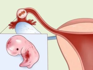 Что может болеть во время месячных маточные трубы