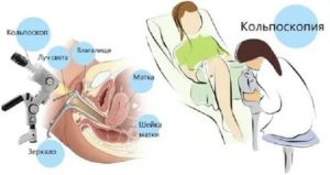 Когда лучше делать кольпоскопию шейки матки до месячных или после месячных