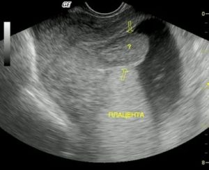 Узи матки плод прикреплен к задней стенке матки