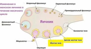 Что такое персистирующее кистозное желтое тело