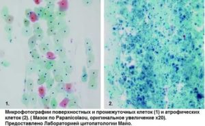 Цитология шейки матки кольпит