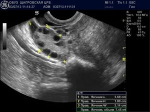 Как выглядит желтое тело на узи перед месячными