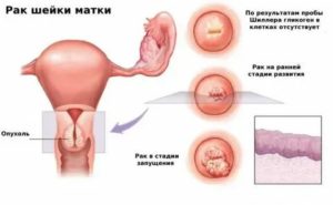 Молочница при раке шейки матки