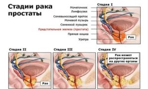 Голодание при раке предстательной железы