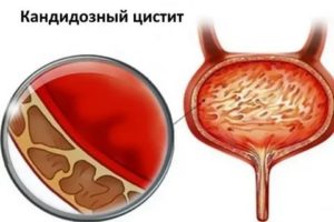 Кандидоз мочевого пузыря симптомы и лечение