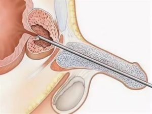 Интрауретральное лечение простатита
