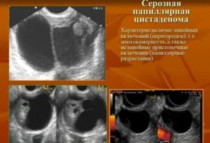 Что такое киста правого яичника папиллярная цистаденома