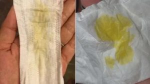 Жидкие выделения при молочнице на 35 неделе беременности