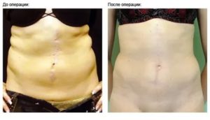 Эндометриоз послеоперационного рубца передней брюшной стенки операция