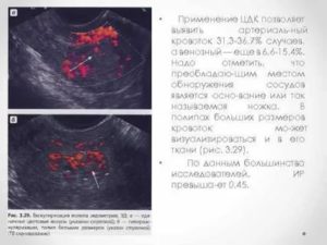 Цветовые локусы на узи в эндометрии