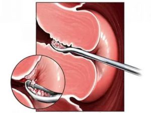 Как прижигают кисты шейки матки что это такое