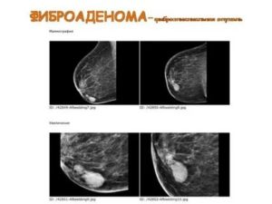 Может ли киста молочной железы перерасти в фиброаденому молочной железы