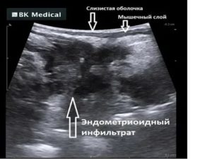 Эндометриоз когда делать узи чтобы его определить