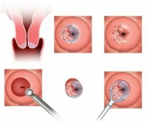 Когда можно заниматься сексом после прижигания кисты на шейке матки
