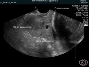 Снимок матки на узи при беременности