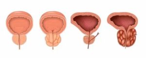 Что такое малигнизация предстательной железы