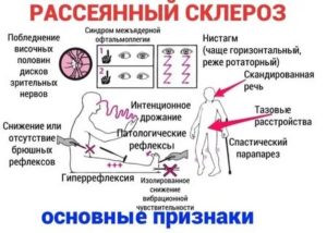 Влияние климакса на рассеянный склероз