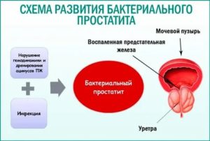 Хронический бактериальный простатита безопасен для женщин