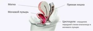 Препараты для лечения цистоцеле