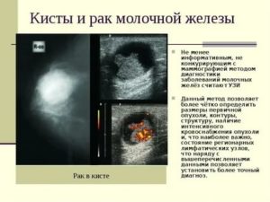 Можно ли перепутать рак с кистой молочной железы