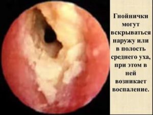Кандидозный отит наружный