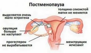 Жидкость в матке при климаксе причины и лечение