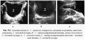 Аплазия матки по узи