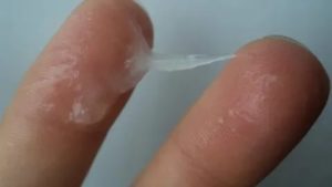 Жидкие как вода выделения при молочнице