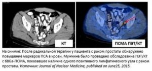 Пэт кт при раке яичников