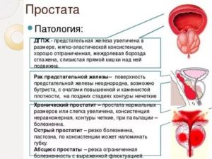 Что такое хронический простатит при таком диагнозе могут быть дети