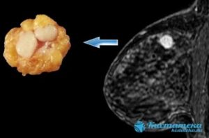 Что такое аденома и киста молочной железы