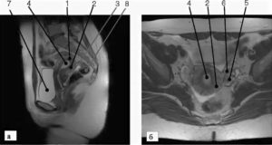Мрт анатомия матки и придатков