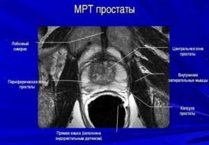 Анатомия предстательной железы по мрт