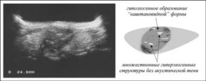 Гипоэхогенное образование в матке по узи