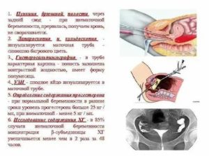 Пункция при диагностики внематочной беременности
