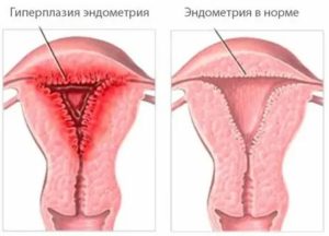 Эндометриоз и гиперплазия матки это одно заболевание или нет