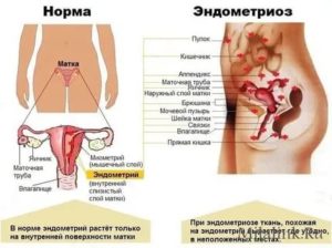Что происходит с кишечником во время месячных