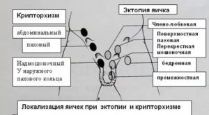 Хгч при гипоплазии яичек