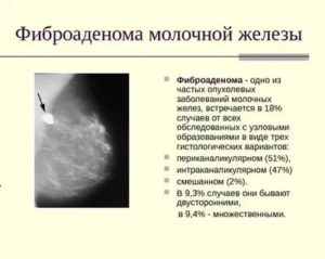 Лечение фиброаденомы молочной железы лекарственными препаратами