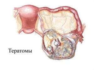 Опухоль тератома яичника симптомы